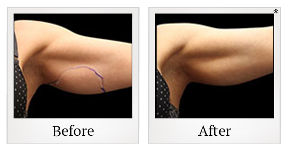 Before and After Photo 39 of Exilis Ultra 360™ treatment at SF Bay Cosmetic Surgery Medical Group in San Ramon