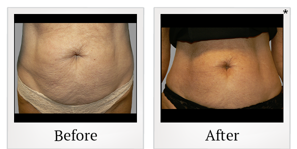 Before and After Photo 4 of Exilis Ultra 360™ treatment at SF Bay Cosmetic Surgery Medical Group in San Ramon