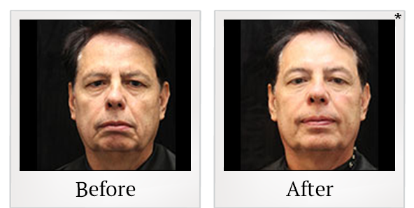 Before and After Photo 40 of Exilis Ultra 360™ treatment at SF Bay Cosmetic Surgery Medical Group in San Ramon