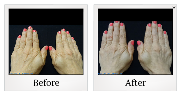 Before and After Photo 41 of Exilis Ultra 360™ treatment at SF Bay Cosmetic Surgery Medical Group in San Ramon