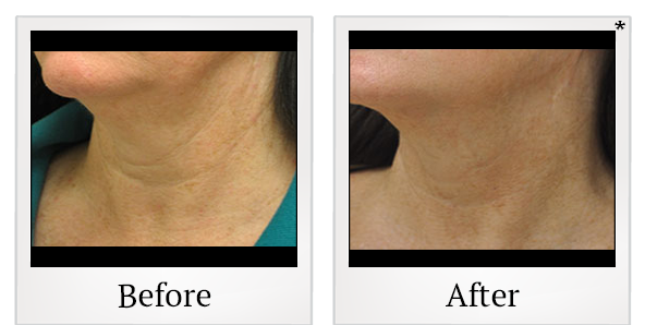 Before and After Photo 42 of Exilis Ultra 360™ treatment at SF Bay Cosmetic Surgery Medical Group in San Ramon