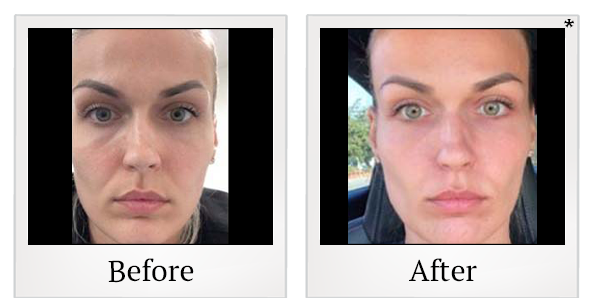 Before and After Photo 43 of Exilis Ultra 360™ treatment at SF Bay Cosmetic Surgery Medical Group in San Ramon