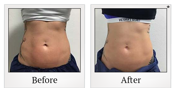 Before and After Photo 44 of Exilis Ultra 360™ treatment at SF Bay Cosmetic Surgery Medical Group in San Ramon