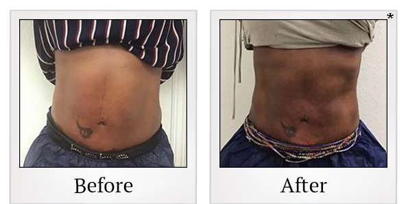 Before and After Photo 45 of Exilis Ultra 360™ treatment at SF Bay Cosmetic Surgery Medical Group in San Ramon