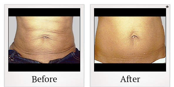 Before and After Photo 5 of Exilis Ultra 360™ treatment at SF Bay Cosmetic Surgery Medical Group in San Ramon