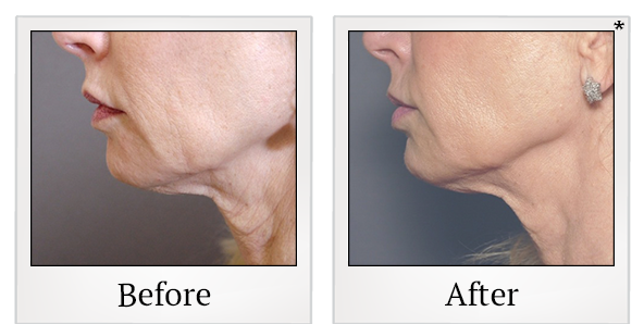 Before and After Photo 6 of Exilis Ultra 360™ treatment at SF Bay Cosmetic Surgery Medical Group in San Ramon