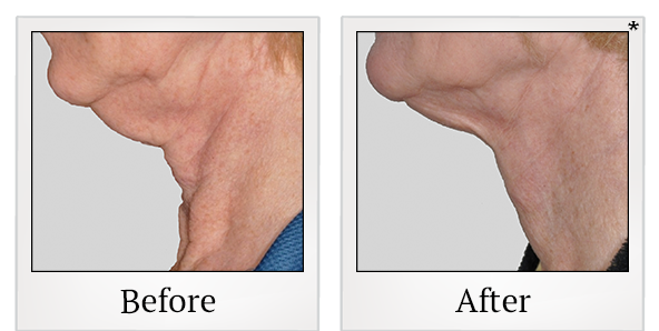 Before and After Photo 7 of Exilis Ultra 360™ treatment at SF Bay Cosmetic Surgery Medical Group in San Ramon