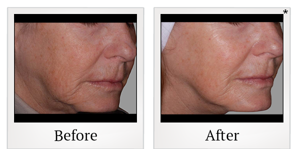 Before and After Photo 8 of Exilis Ultra 360™ treatment at SF Bay Cosmetic Surgery Medical Group in San Ramon