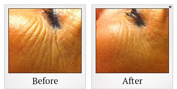 Before and After Photo 9 of Exilis Ultra 360™ treatment at SF Bay Cosmetic Surgery Medical Group in San Ramon