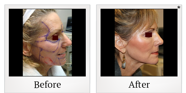Before and After Photo 1 of Facial Rejuvenation treatment at SF Bay Cosmetic Surgery Medical Group in San Ramon