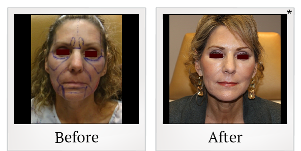 Before and After Photo 2 of Facial Rejuvenation treatment at SF Bay Cosmetic Surgery Medical Group in San Ramon