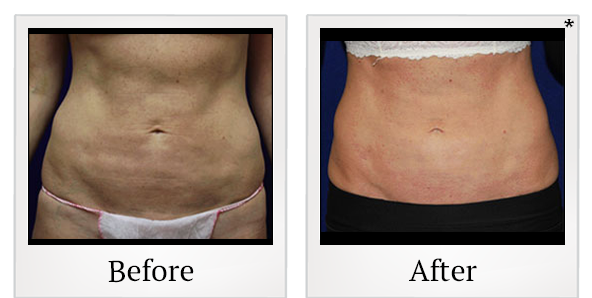 Before and After Photo 1 of Fat Transfers treatment at SF Bay Cosmetic Surgery Medical Group in San Ramon
