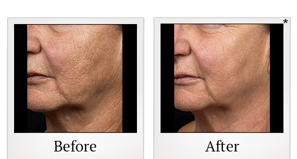 Before and After Photo 1 of Fraxel® treatment at SF Bay Cosmetic Surgery Medical Group in San Ramon