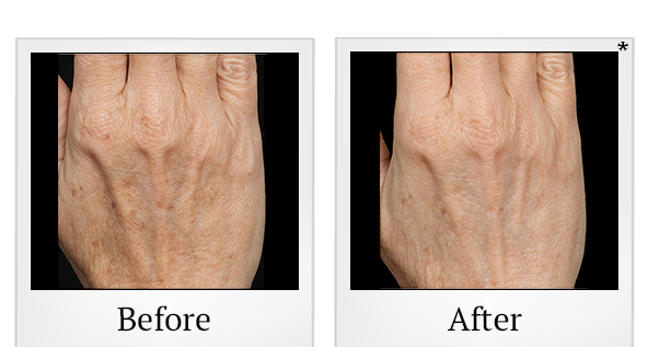 Before and After Photo 2 of Fraxel® treatment at SF Bay Cosmetic Surgery Medical Group in San Ramon