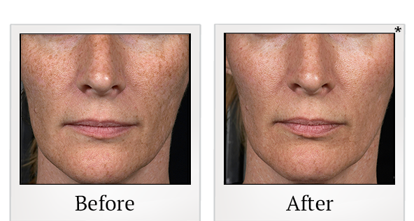 Before and After Photo 3 of Fraxel® treatment at SF Bay Cosmetic Surgery Medical Group in San Ramon