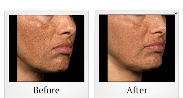 Before and After Photo 4 of Fraxel® treatment at SF Bay Cosmetic Surgery Medical Group in San Ramon