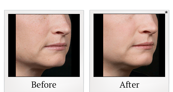 Before and After Photo 5 of Fraxel® treatment at SF Bay Cosmetic Surgery Medical Group in San Ramon