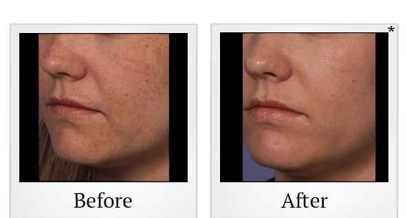 Before and After Photo 6 of Fraxel® treatment at SF Bay Cosmetic Surgery Medical Group in San Ramon