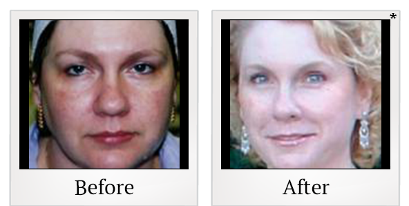 Before and After Photo 1 of IPL Photo Facial treatment at SF Bay Cosmetic Surgery Medical Group in San Ramon
