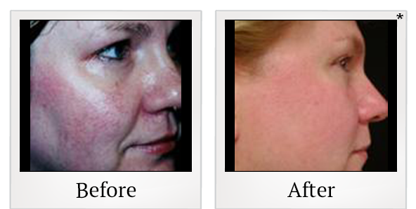 Before and After Photo 2 of IPL Photo Facial treatment at SF Bay Cosmetic Surgery Medical Group in San Ramon
