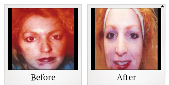Before and After Photo 3 of IPL Photo Facial treatment at SF Bay Cosmetic Surgery Medical Group in San Ramon
