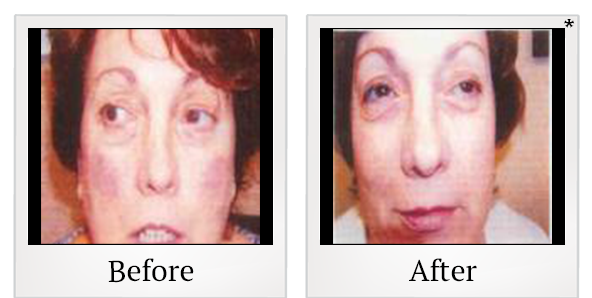 Before and After Photo 4 of IPL Photo Facial treatment at SF Bay Cosmetic Surgery Medical Group in San Ramon