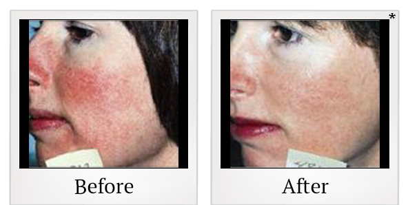 Before and After Photo 5 of IPL Photo Facial treatment at SF Bay Cosmetic Surgery Medical Group in San Ramon
