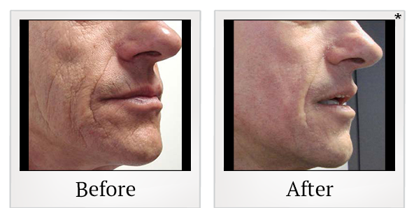 Before and After Photo 1 of JPlasma Portrait treatment at SF Bay Cosmetic Surgery Medical Group in San Ramon