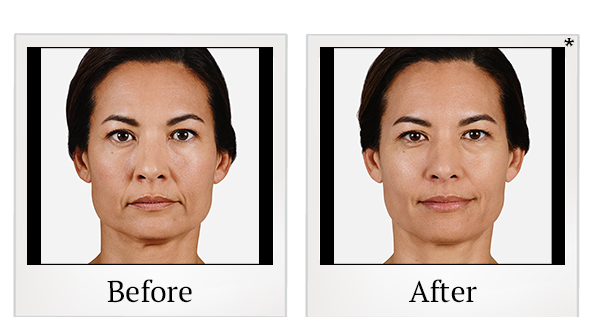 Before and After Photo 1 of Juvéderm® treatment at SF Bay Cosmetic Surgery Medical Group in San Ramon