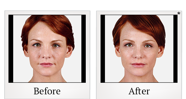 Before and After Photo 10 of Juvéderm® treatment at SF Bay Cosmetic Surgery Medical Group in San Ramon