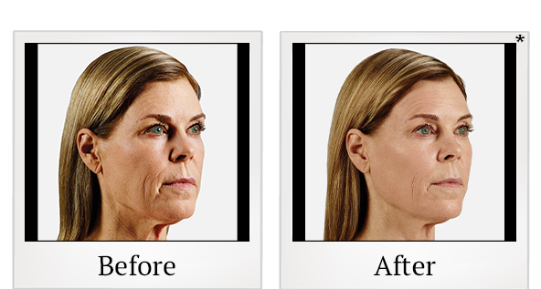 Before and After Photo 11 of Juvéderm® treatment at SF Bay Cosmetic Surgery Medical Group in San Ramon