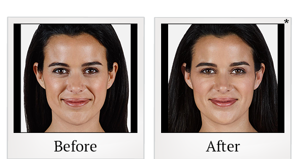 Before and After Photo 12 of Juvéderm® treatment at SF Bay Cosmetic Surgery Medical Group in San Ramon