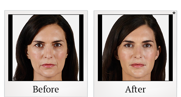 Before and After Photo 13 of Juvéderm® treatment at SF Bay Cosmetic Surgery Medical Group in San Ramon