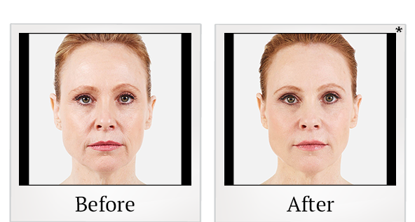 Before and After Photo 14 of Juvéderm® treatment at SF Bay Cosmetic Surgery Medical Group in San Ramon
