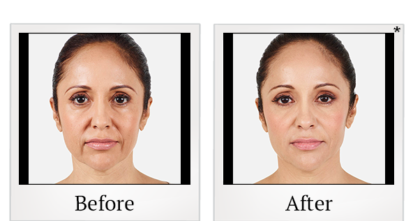 Before and After Photo 15 of Juvéderm® treatment at SF Bay Cosmetic Surgery Medical Group in San Ramon