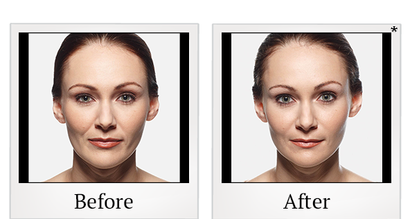 Before and After Photo 16 of Juvéderm® treatment at SF Bay Cosmetic Surgery Medical Group in San Ramon