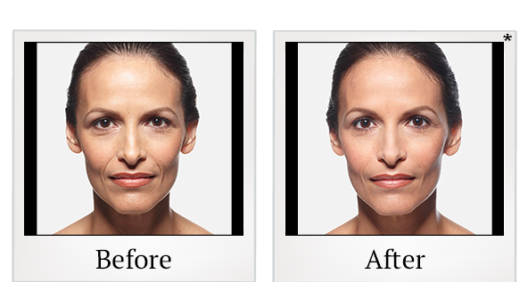 Before and After Photo 17 of Juvéderm® treatment at SF Bay Cosmetic Surgery Medical Group in San Ramon