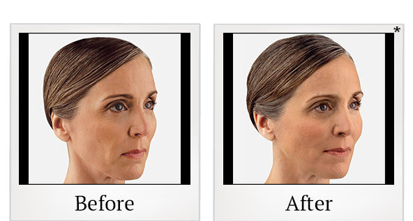 Before and After Photo 18 of Juvéderm® treatment at SF Bay Cosmetic Surgery Medical Group in San Ramon