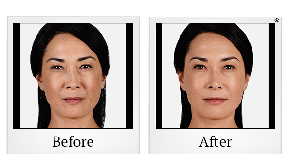 Before and After Photo 19 of Juvéderm® treatment at SF Bay Cosmetic Surgery Medical Group in San Ramon