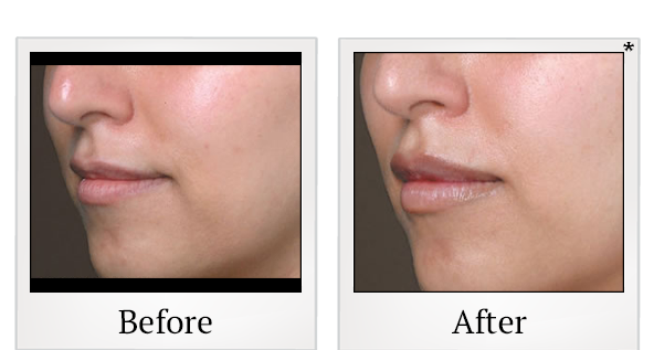 Before and After Photo 2 of Juvéderm® treatment at SF Bay Cosmetic Surgery Medical Group in San Ramon