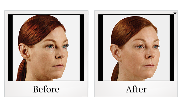 Before and After Photo 20 of Juvéderm® treatment at SF Bay Cosmetic Surgery Medical Group in San Ramon
