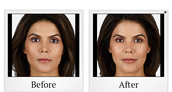 Before and After Photo 3 of Juvéderm® treatment at SF Bay Cosmetic Surgery Medical Group in San Ramon