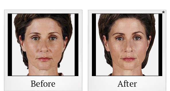 Before and After Photo 4 of Juvéderm® treatment at SF Bay Cosmetic Surgery Medical Group in San Ramon