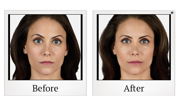 Before and After Photo 5 of Juvéderm® treatment at SF Bay Cosmetic Surgery Medical Group in San Ramon