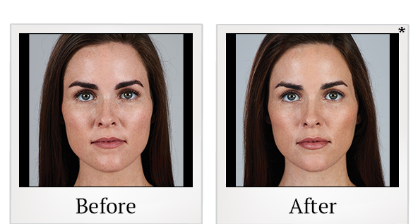 Before and After Photo 6 of Juvéderm® treatment at SF Bay Cosmetic Surgery Medical Group in San Ramon