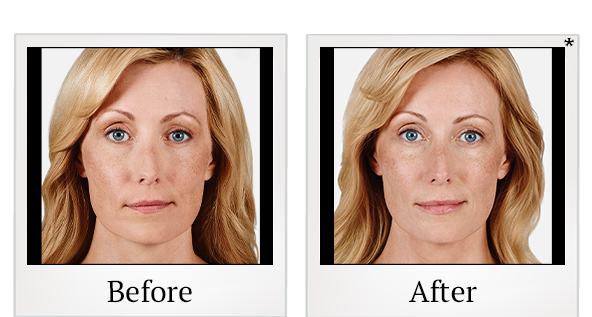 Before and After Photo 7 of Juvéderm® treatment at SF Bay Cosmetic Surgery Medical Group in San Ramon