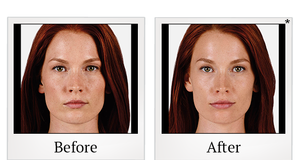 Before and After Photo 8 of Juvéderm® treatment at SF Bay Cosmetic Surgery Medical Group in San Ramon