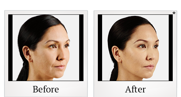 Before and After Photo 9 of Juvéderm® treatment at SF Bay Cosmetic Surgery Medical Group in San Ramon