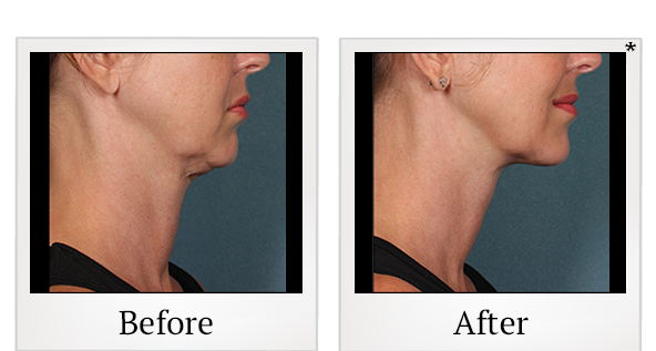 Before and After Photo 1 of Kybella® treatment at SF Bay Cosmetic Surgery Medical Group in San Ramon