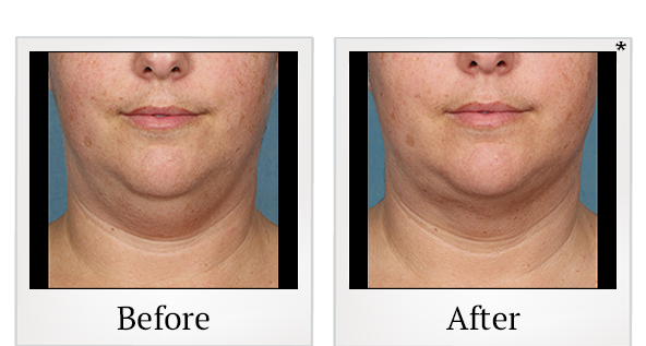 Before and After Photo 2 of Kybella® treatment at SF Bay Cosmetic Surgery Medical Group in San Ramon